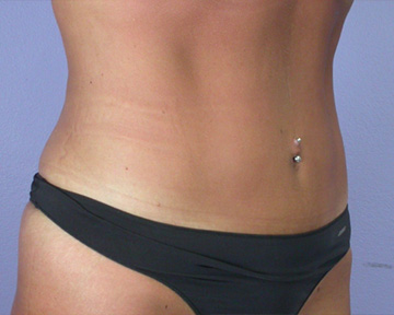 Tummy Tuck before and after photo