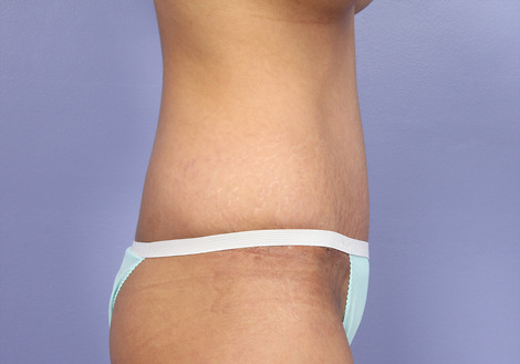 Tummy Tuck before and after photo