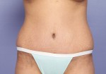 Tummy Tuck Before and after photo