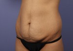 Tummy Tuck Before and after photo