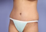 Tummy Tuck Before and after photo