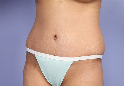 Tummy Tuck before and after photo