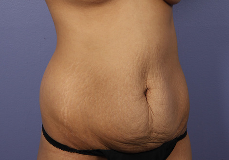 Tummy Tuck before and after photo