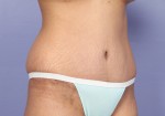 Tummy Tuck Before and after photo