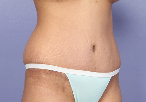 Tummy Tuck before and after photo