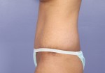 Tummy Tuck Before and after photo