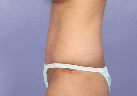 Tummy Tuck before and after photo