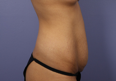 Tummy Tuck before and after photo