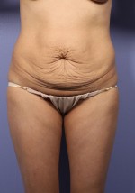 Tummy Tuck Before and after photo