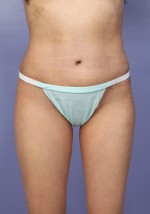 Tummy Tuck