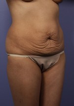 Tummy Tuck Before and after photo