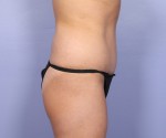 Tummy Tuck Before and after photo