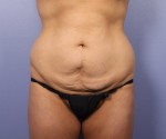 Tummy Tuck