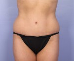 Tummy Tuck Before and after photo