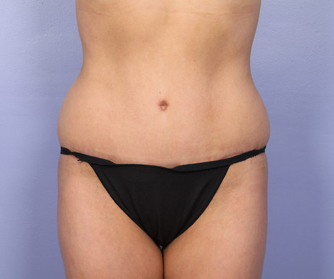 Tummy Tuck before and after photo