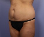 Tummy Tuck