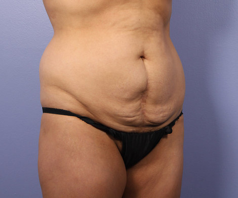 Tummy Tuck before and after photo