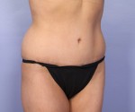 Tummy Tuck Before and after photo