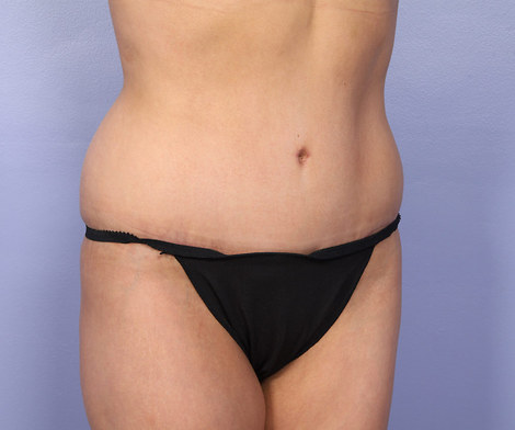 Tummy Tuck before and after photo