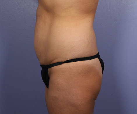 Tummy Tuck before and after photo