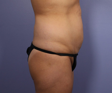 Tummy Tuck before and after photo