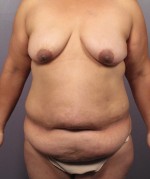 Tummy Tuck Before and after photo