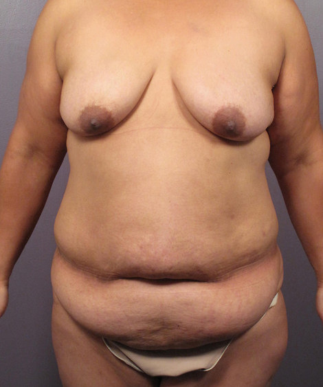 Tummy Tuck before and after photo