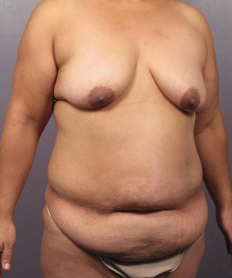 Tummy Tuck before and after photo