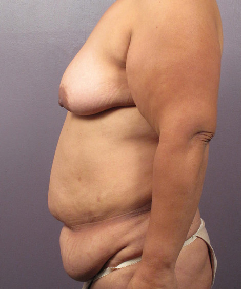 Tummy Tuck before and after photo