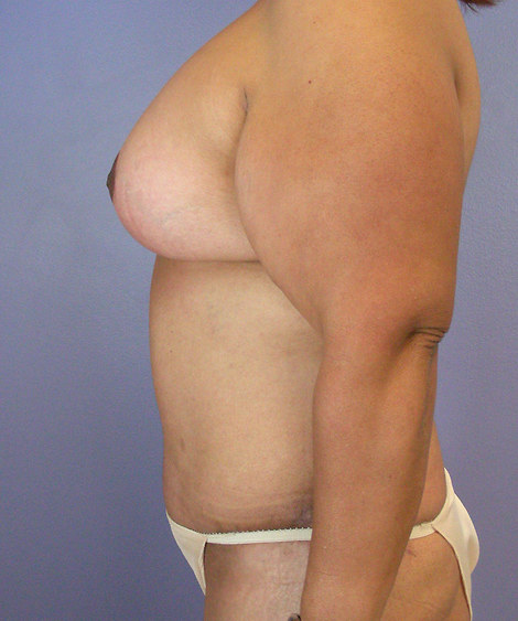 Tummy Tuck before and after photo