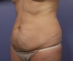 Tummy Tuck Before and after photo