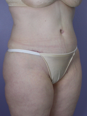 Tummy Tuck before and after photo