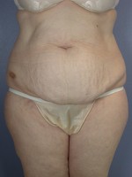 Tummy Tuck Before and after photo