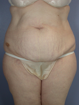 Tummy Tuck before and after photo