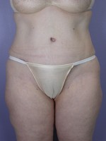 Tummy Tuck Before and after photo