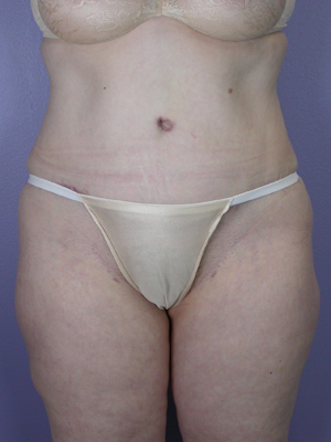 Tummy Tuck before and after photo