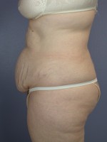 Tummy Tuck Before and after photo