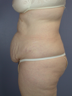 Tummy Tuck before and after photo