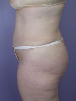 Tummy Tuck Before and after photo