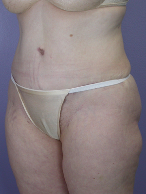 Tummy Tuck before and after photo