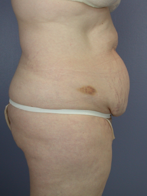 Tummy Tuck before and after photo