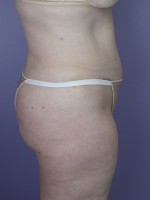 Tummy Tuck Before and after photo