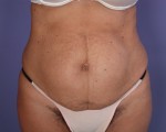 Tummy Tuck Before and after photo