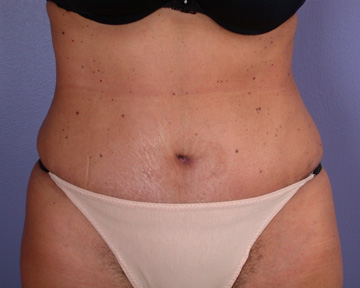 Tummy Tuck before and after photo