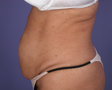 Tummy Tuck before and after photo