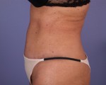 Tummy Tuck Before and after photo