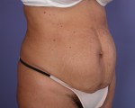 Tummy Tuck Before and after photo