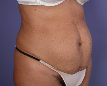 Tummy Tuck before and after photo