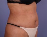 Tummy Tuck Before and after photo