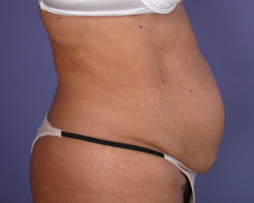 Tummy Tuck before and after photo